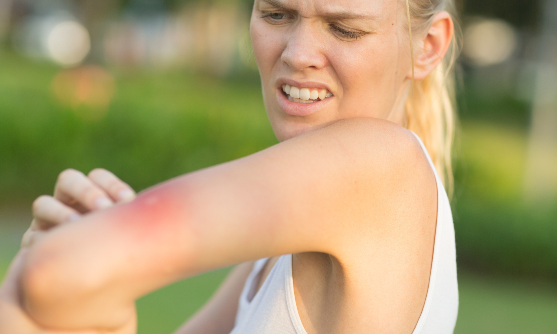 Punture di insetti in estate: cosa fare davvero Donna all’aperto osserva una puntura sul braccio, simbolo di prurito, rossore e irritazione causati dagli insetti in estate.